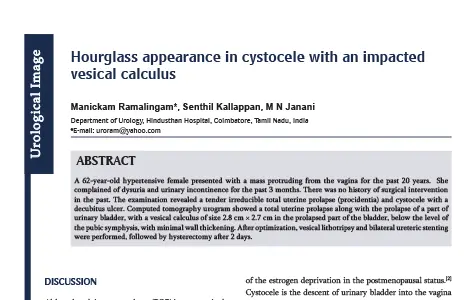 Hourglass appearance in cystocele with an impacted vesical calculus